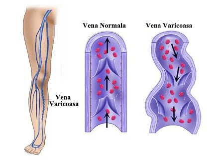 Conuri pe venele picioarelor: cauzele și metodele de tratament